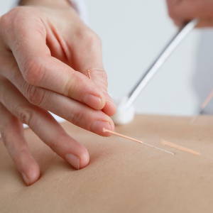 Akupunktur